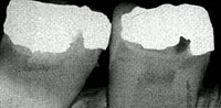 Tooth x-ray